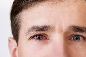 Image result for Acute Red Eye