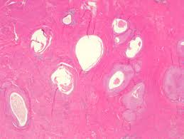 Brenner Tumor An Overview Sciencedirect Topics