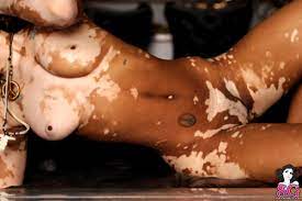 Vitiligo porn