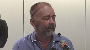 Médicos estadounidenses realizan el primer trasplante de cráneo y cuero  cabelludo