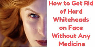 Apply the warm compress 10 to. How To Get Rid Of Hard Whiteheads On Face Without Any Medicine