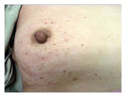 What Are the Common Causes of Freckles on Breasts?