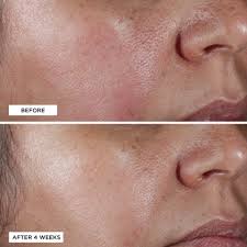 Sometimes, the pores could also get clogged, when the human skin is steaming your face can open the clogged pores and let all types of impurities trapped inside to be eliminated well. 22 Products That Ll Help You Deal With Big Pores