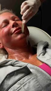 It’s amazing what a little aesthetic touch can do! Come see us for a quick  pick me up! #shoredermatology #marylanddermatology