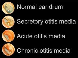 What Otitis Media Looks Like As Infographic Nursepractitioner Aprns Nursingstudent Nurse Practitioner School Pediatric Nursing Pediatric Nurse Practitioner