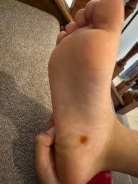 Image result for brown patches on the feet
