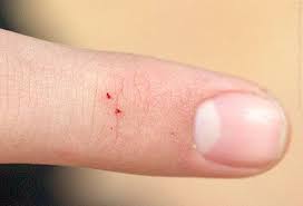 Bug Bites Pictures Slideshow Identifying Bugs And Bug Bites Spider Bites Home Health Remedies Home Remedies For Spiders