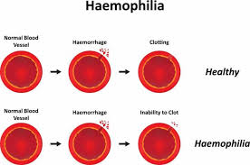 Without enough factor viii, the blood cannot clot properly to control bleeding. Melawan Hemofilia Warisan Yang Tak Diinginkan Halaman All Kompasiana Com