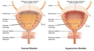 Image result for Urinary Incontinence