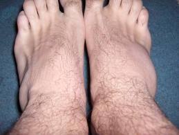 In diagnosticul diferential, medicul poate lua in considerare o serie de afectiuni, intre care tromboza venoasa profunda, chist baker rupt sau vene varicoase unilateral. Cum Sa Reduci Timpul De Vindecare A Unei Luxatii Sau Entorse Infuzie De SÄƒnÄƒtate