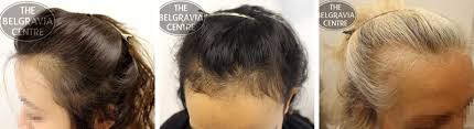 As our body shuts down and conserves to survive, the skin, our largest organ suffers, especially our hair. Guide To Hair Loss Conditions Diagnose Yourself