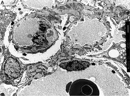 Haas m (2009) alport syndrome and thin glomerular basement membrane nephropathy: Ocular Abnormalities In Thin Basement Membrane Disease British Journal Of Ophthalmology