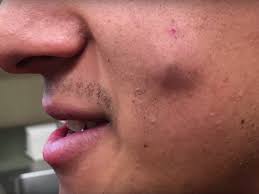 There are many causes of boils. Best Cyst Popping Videos Of 2018 Insider