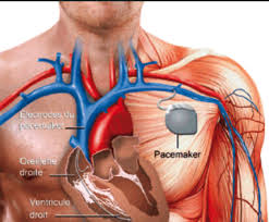 The pacemaker is an electronic biomedical device that can regulate the human heartbeat when its the quality of each pacemaker is ensured by making visual and electrical inspections throughout the. Pacemaker Implantation 7 Orange Hospital Cardiology Heart Hospital Pcmc Pune Pune
