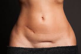 Exercises To Avoid After A C Section C Section Workout After C Section Workout Post Baby Workout