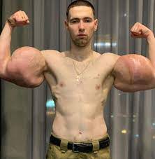 The former soldier became an internet sensation after sharing pictures of his cartoonish arms. Russian Bodybuilder With 24 Inch Oil Injected Popeye Biceps Has Surgery To Save Arms After Warnings He D Die