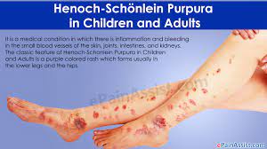 The inflammationcauses bloodvessels in the skin, intestines, kidneys,. Henoch Schonlein Purpura In Children And Adults