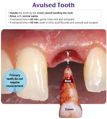 Image result for Tooth Luxation