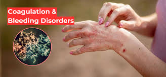 Image result for Coagulation Bleeding Disorder