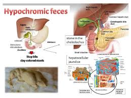 Image result for acholic stools human