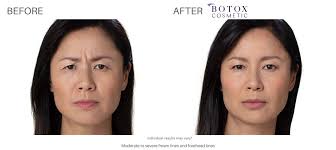 Muscle relaxant to the glabella (smooths and refreshes. Botox And Dermal Fillers Newport News Numa Spa