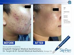 You Won T Believe The Amazing Results The Skinpen Achieved On Acnescars With Only 3 Microneedling Treatments