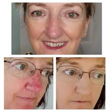 Rosacea is aggravating to say the least! Some makeup foundations wouldn't  sit right