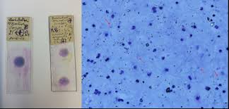 Frequently asked questions about malaria, disease, transmission, symptoms, diagnosis, treatment, complications with pregnancy, prevention, eradication and endemic areas. 1940s Blood Samples Reveal Historical Spread Of Malaria Ucl Division Of Biosciences Ucl University College London