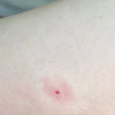 Zeckenbiss Oder Nur Ein Stich Gesundheit Arzt Krankheit