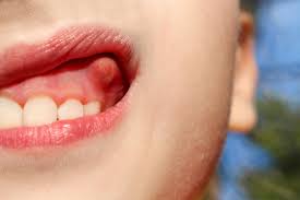 5 Home Remedies For Swollen Gums