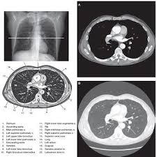 Chest Ct Ct Scan Radiology Imaging Diagnostic Imaging