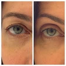 Want An Eye Lift Without Surgery Here S How Botox Brow Lift Eye Lift Brow Lift