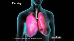 Indirectly, lupus can lead to cardiovascular problems. Lupus Youtube