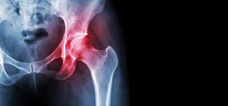 Bei coxarthrose wirst du, würde ich einmal vermuten, auf dauer nicht um einen gelenkersatz. Huftarthrose Und Huftendoprothese Orthopaedicum Frankfurt