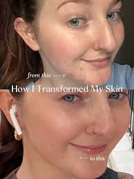 How I Transformed My Skin