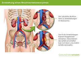 Aneurysma Ursachen Symptome Diagnose Behandlung