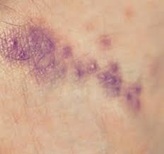 Use the pictures and information below to help you identify bug bites and stings. Identify Bug Bites Common Bug Bites Orkin