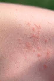 Image result for sweat rash on back baby