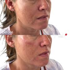 Hello gorgeous.. 🫦 Beautiful results following a full syringe treatment  💉✨ pretty, plump & perfect! Please note: areas of bruising and swelling  are normal following lip filler procedures. I tell clients to