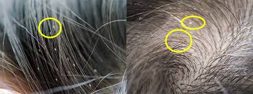 Does rubbing alcohol kill nits? Head Lice Pictures What Color Are Lice Licefreee