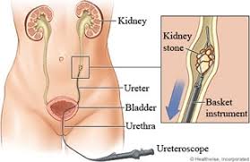 Kidney Stones Urologist North Miami Minimally Invasive Surgery
