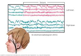 Image result for Absence Seizure