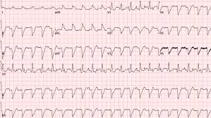 Myocarditis is an inflammatory disease of the myocardium with a wide range of clinical presentations, from subtle to devastating. Cureus Acute Myocarditis Presenting As Acute Coronary Syndrome