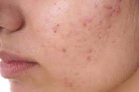 How long does a sharpie last on skin? How Long Does Skin Purging Last Skin Care Geeks