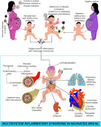 Image result for Multisystem Inflammatory Syndrome