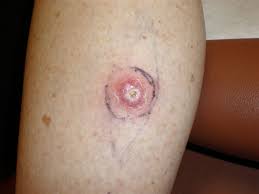 The sore might persist for weeks, or appear to heal and then come back. Skin Cancer Rencic Dermatology