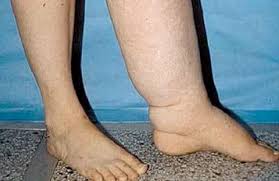 Techet Limfa Iz Nog Chto Eto Chem Grozit Kak Lechit