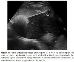 The mature teratoma is by far the most common ovarian germ cell tumor. Squamous Cell Carcinoma In A Newly Diagnosed Ovarian Dermoid Cyst