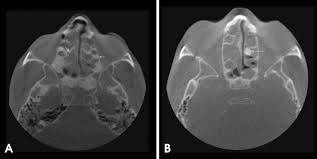 A Axial Cbct Images Show Complete Opacification Of Ethmoidal Air Cells Download Scientific Diagram