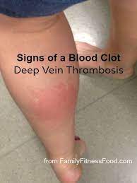 Severe pain in the area where blood has clotted is one of the obvious symptoms of a leg blood clot, also known as deep vein thrombosis. 21 Best Dvt Deep Vein Thrombosis Ideas Deep Vein Thrombosis Thrombosis Dvt